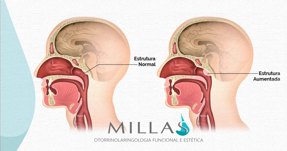 Você sabe o que é “Adenoide”?